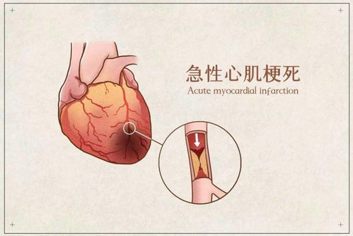 深部输精结束后究竟要不要立即拔管