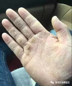 治疗与护理：与鱼鳞病共存