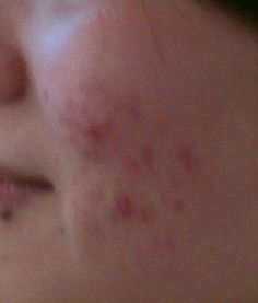 农药溅脸紧急处理：快速缓解小窍门