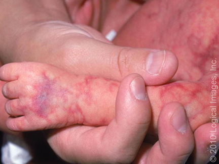 二、 防治红叶石楠叶斑病的方法