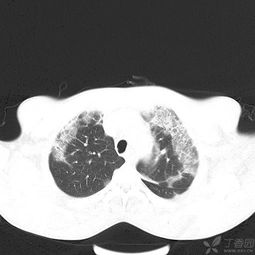 百草枯中毒后肺部纤维化最迟会在多久后出现？