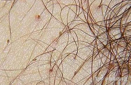 松树脱皮，原来是这么一回事