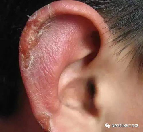 无花果冬天会冻死吗？如何进行冬季保养才能避免冻伤