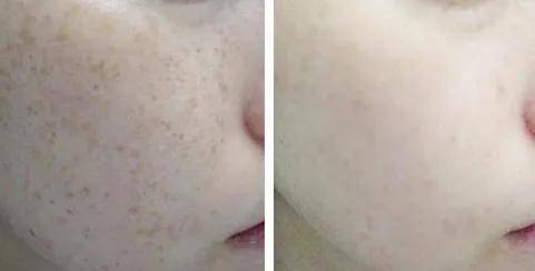 影响恢复时间的因素