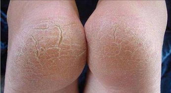 去医院，还是自己先弄弄？