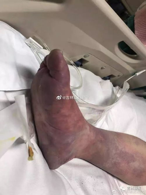 双腿瘫痪的原因有哪些？下肢无力可能带来哪些严重后果？