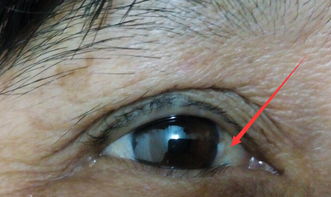 肥猪眼睛红肿肿大看不见眼珠，是何种疾病或因素导致的症状？