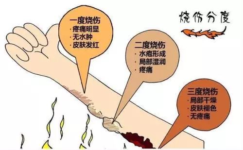 烫伤急救， 这些植物来帮忙