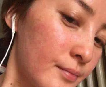 乙草胺过敏，皮肤会有伤害吗？