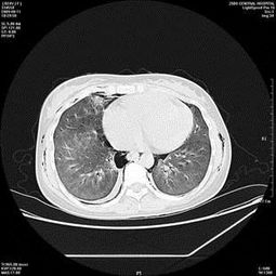 百草枯：无情的毒药， 无解的谜团