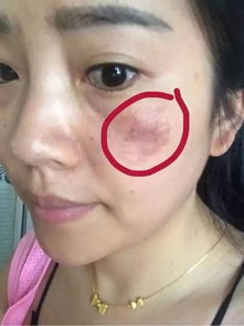 被农药喷到脸上， 痒得我受不了