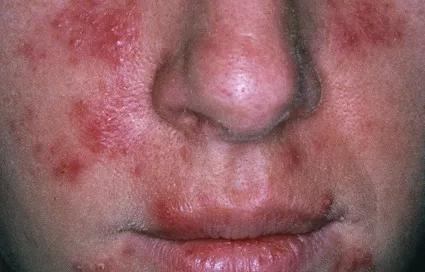 玫瑰痤疮反复发作，选药大揭秘！