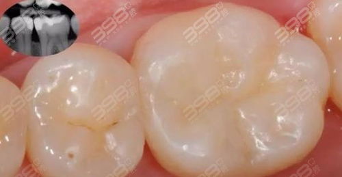 美学树脂补牙，与普通树脂有何区别