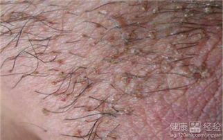 阴虱这个小东西，杀虫剂真的能搞定吗？