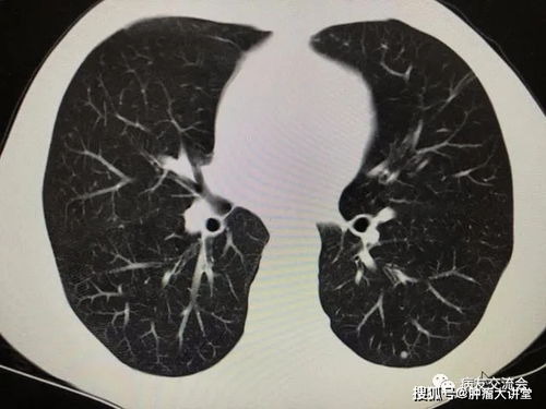 辣椒灰霉病病原物揭秘