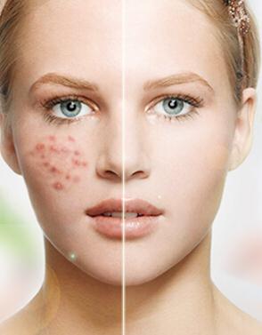 痘痘与痘痘虫，困扰我们的皮肤问题