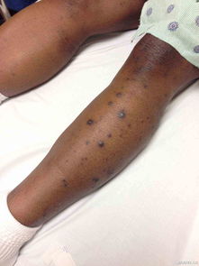 内裤浸泡草甘膦后穿多久会有中毒症状出现？