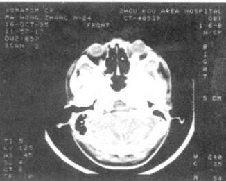 猪囊尾蚴病防控与综合防治策略